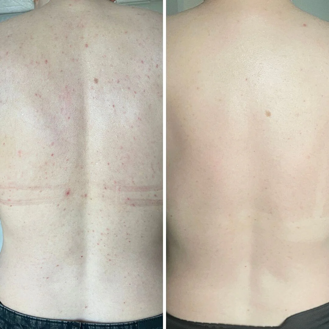 Salicylic acid spray for body blemishes and clogged pores — Salicylic acid spray for breakouts and clogged pores. With 2% salicylic acid and glycolic acid to deeply cleanse and smooth the skin. - Image 6